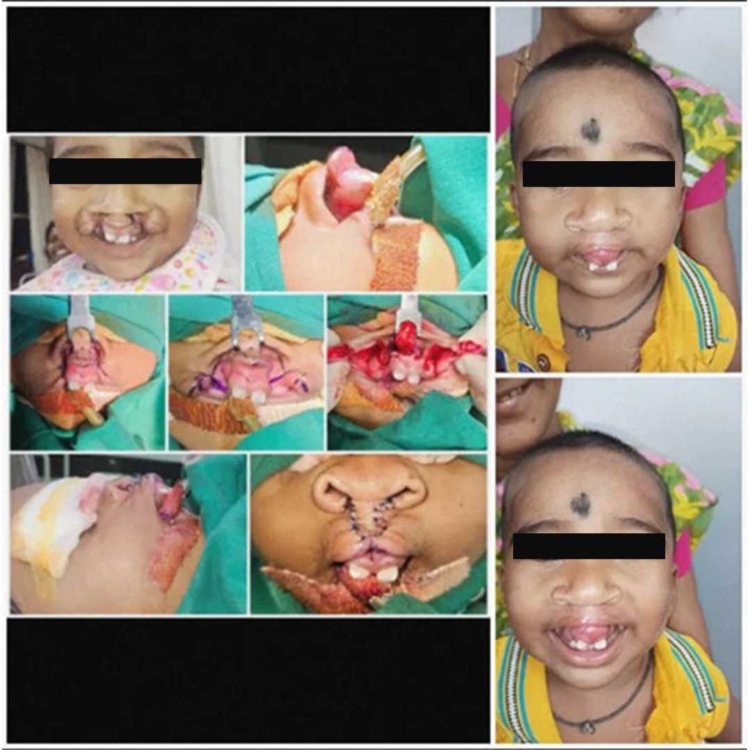 bilateral cleft lip repair